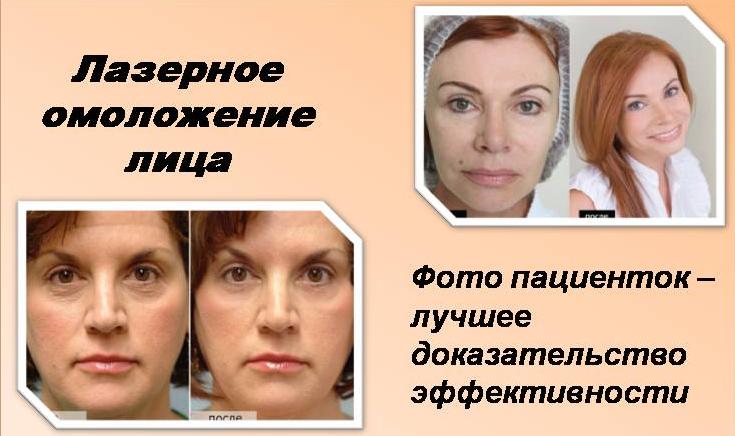 Фото пациенток до и после лазерного лифтинга лица